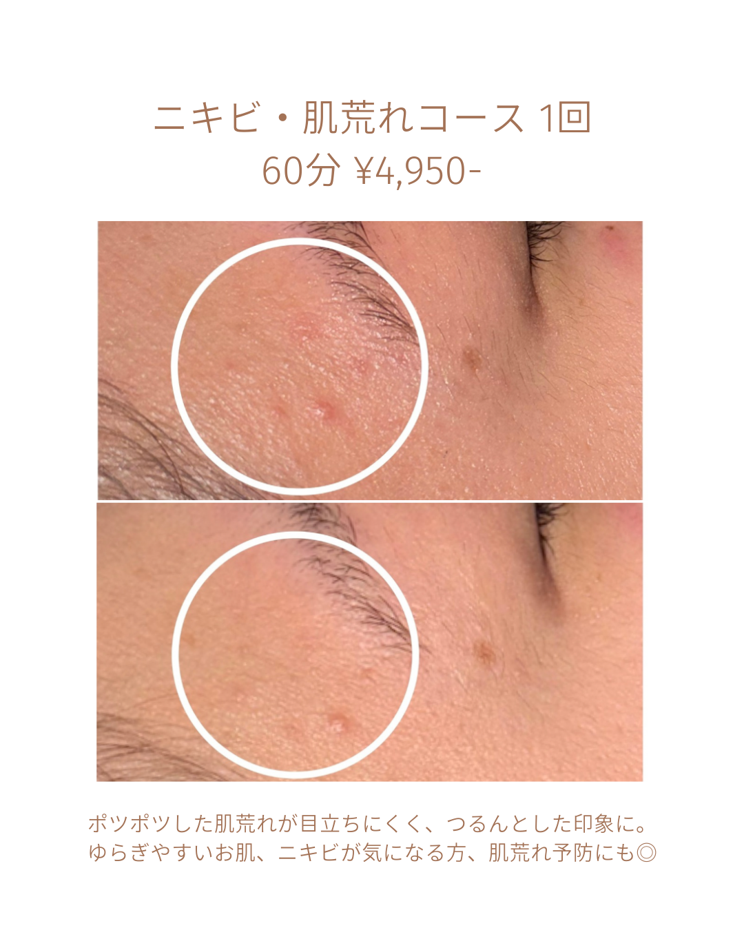 ぷつぷつが目立たなくなり、悩みのあらわれにくい健やかなお肌へ。