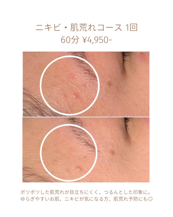 画像1807：エステではなく、ホームケアでお肌をキレイにしました。