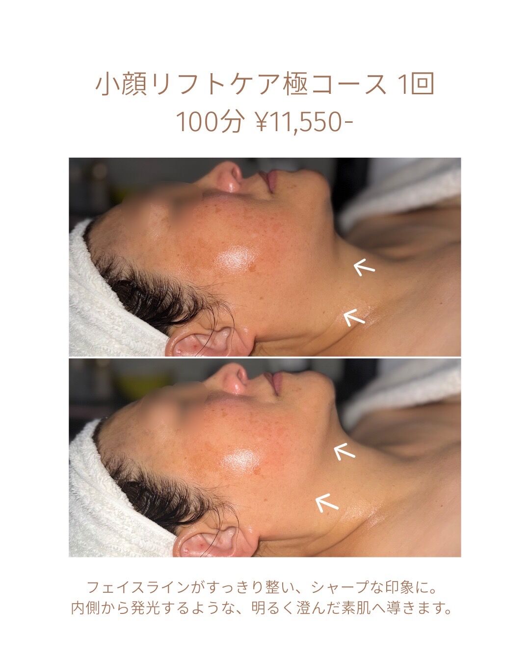 フェイスラインがスッキリ、シュッとした印象へ。