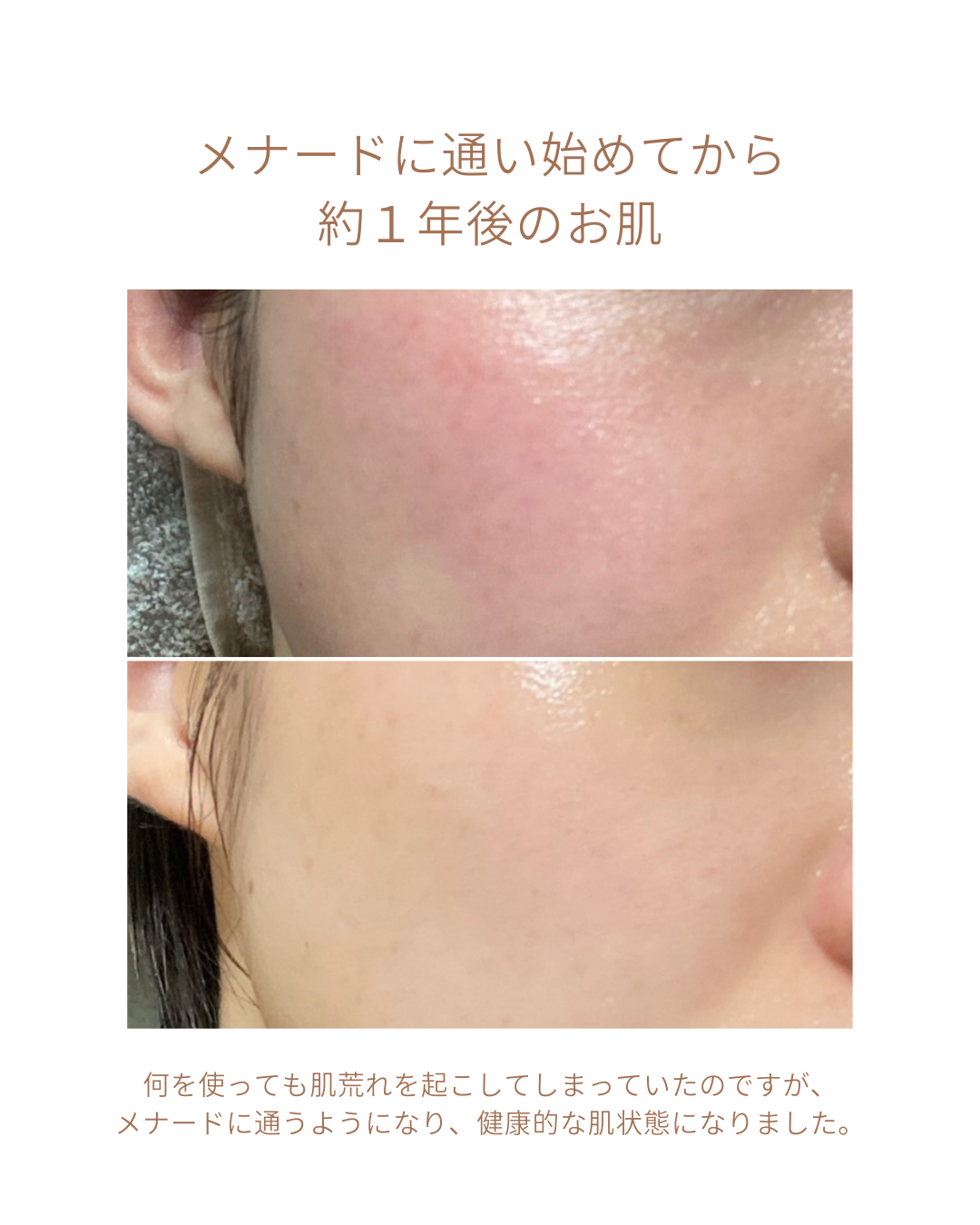 エステではなく、ホームケアでお肌をキレイにしました。