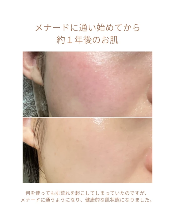画像1815：エステではなく、ホームケアでお肌をキレイにしました。